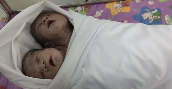 В Мьянме родились сиамские близнецы с общим телом и двумя головами