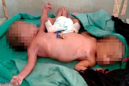 Сиамские близнецы родились с двумя ногами и четырьмя руками