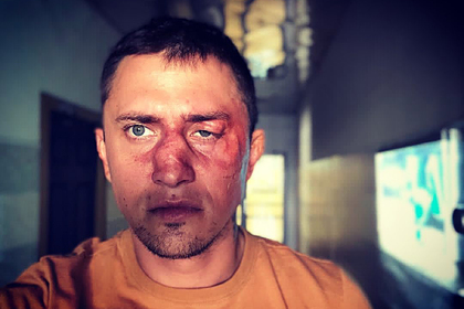Прилучный опубликовал фото с разбитым лицом и рассказал о своем состоянии Прилучный опубликовал фото с разбитым лицом и рассказал о своем состоянии